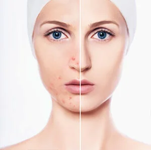 Close up of microneedling treatment