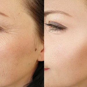 Close up of microneedling treatment