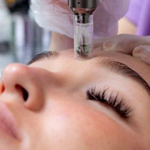 Close up of microneedling treatment