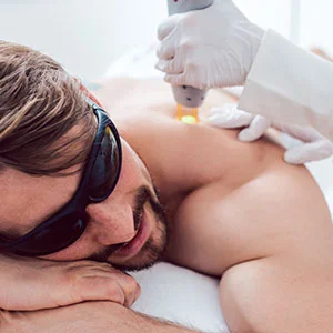 Close up of microneedling treatment