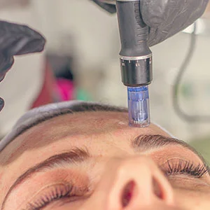 Close up of microneedling treatment