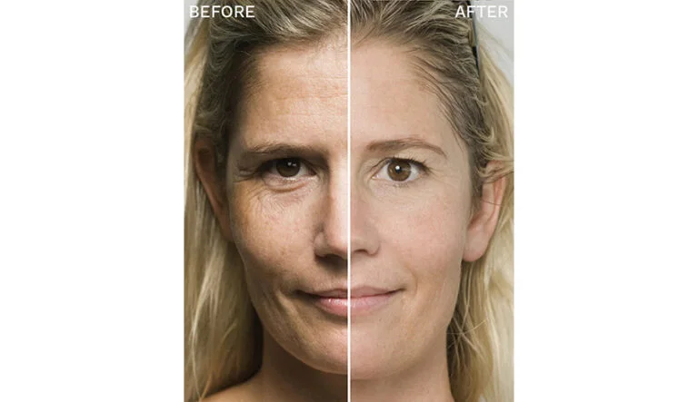 Close up of microneedling treatment