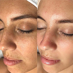 Close up of microneedling treatment