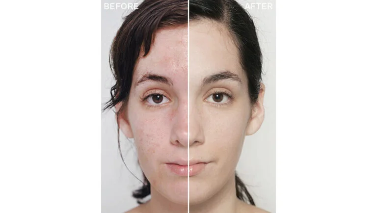 Woman receiving facial treatment