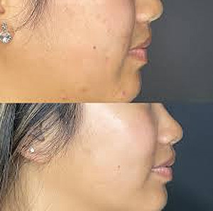 Close up of microneedling treatment