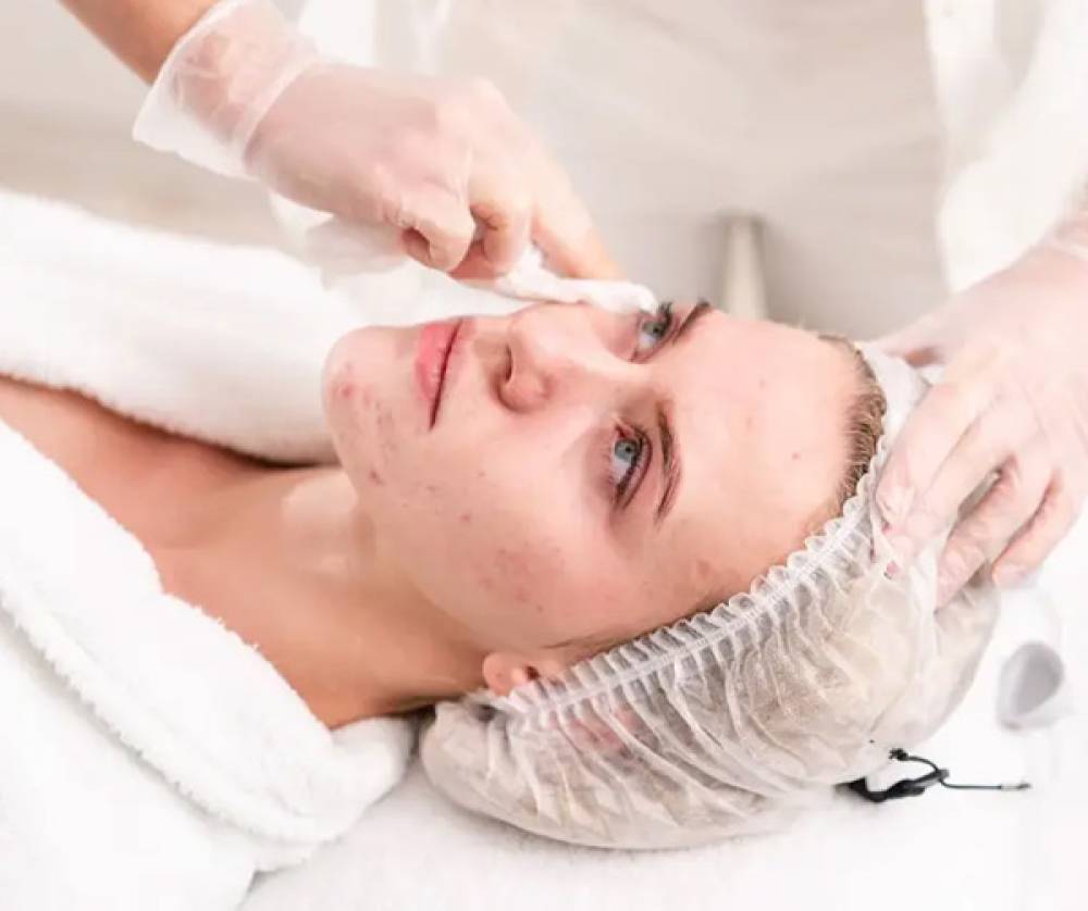 Clear Up Acne Management